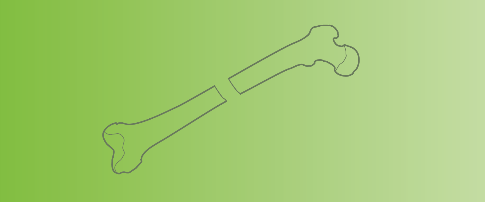 Midshaft Femur