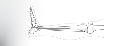 Retrocalcaneal Fusion